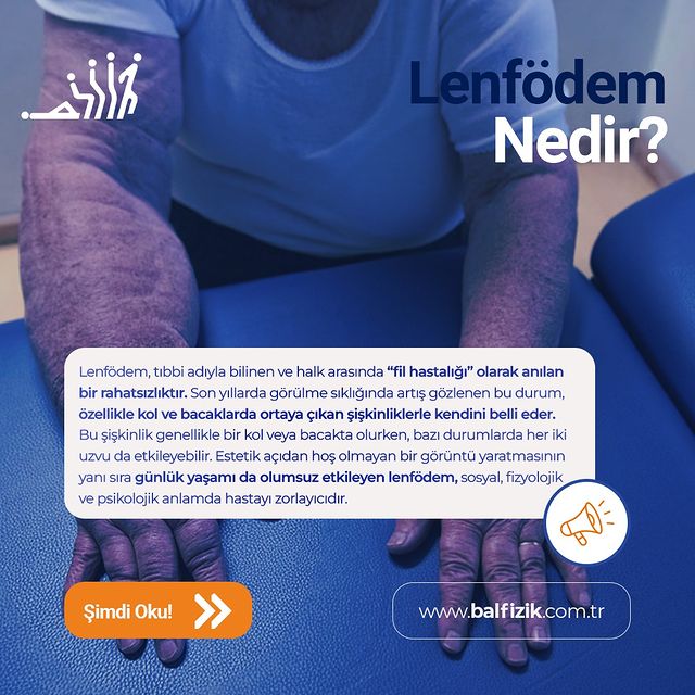 Lenfödem: Halk Arasında 